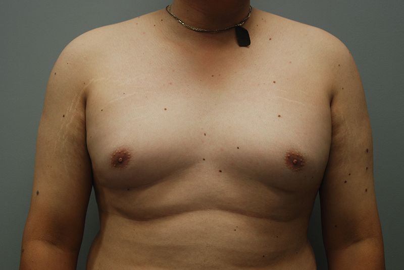Male Breast Reduction - Before