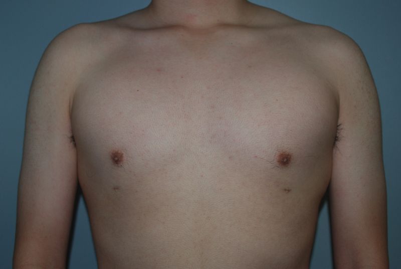 Male Breast Reduction - After