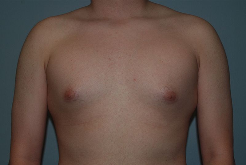 Male Breast Reduction - Before