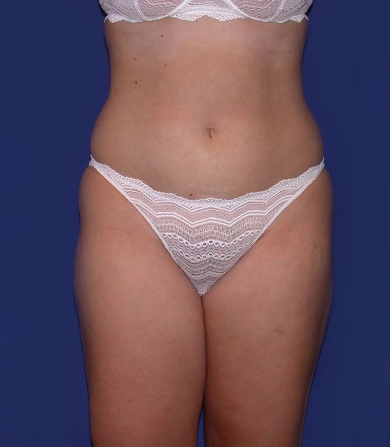 After Tummy Tuck Surgery by Dr. Bermudez in San Francisco