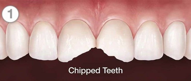 Chipped Tooth Image