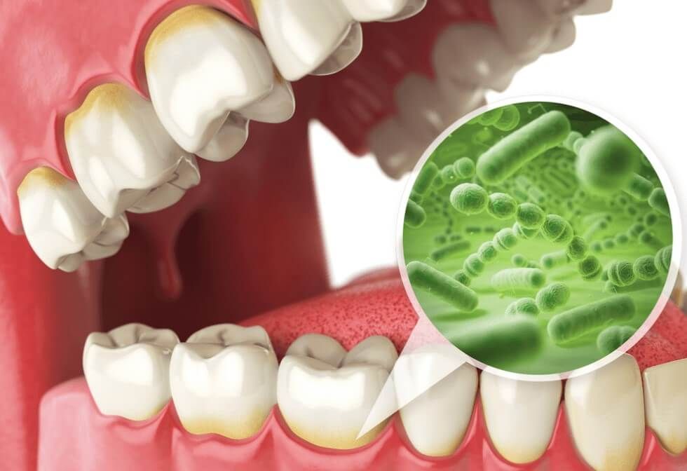 periodontal disease illustration