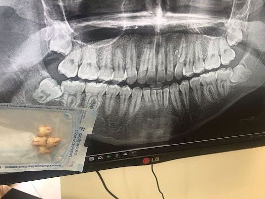 Should I go under for my wisdom teeth removal or stay awake. Houston Texas