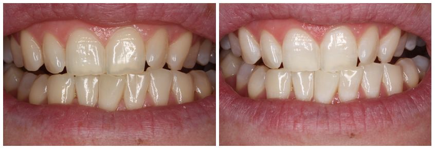 zoom whitening houston zoom whitening houston
