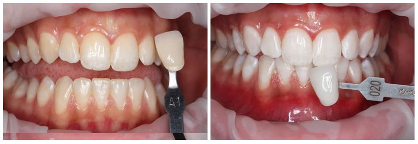 zoom whitening houston zoom whitening houston