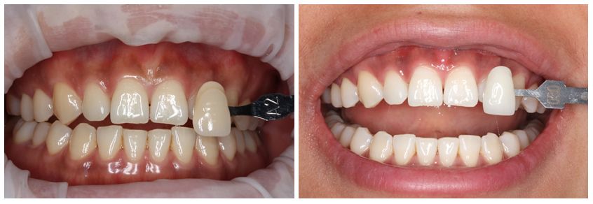 zoom whitening houston zoom whitening houston