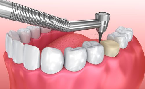 dental crown keem dentistry
