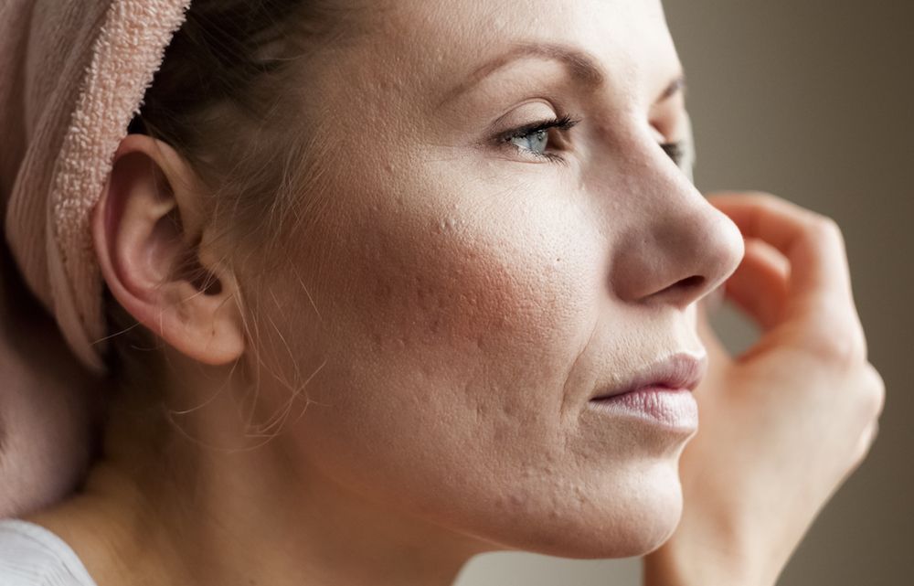 How Can I Get Rid of Acne Scars?