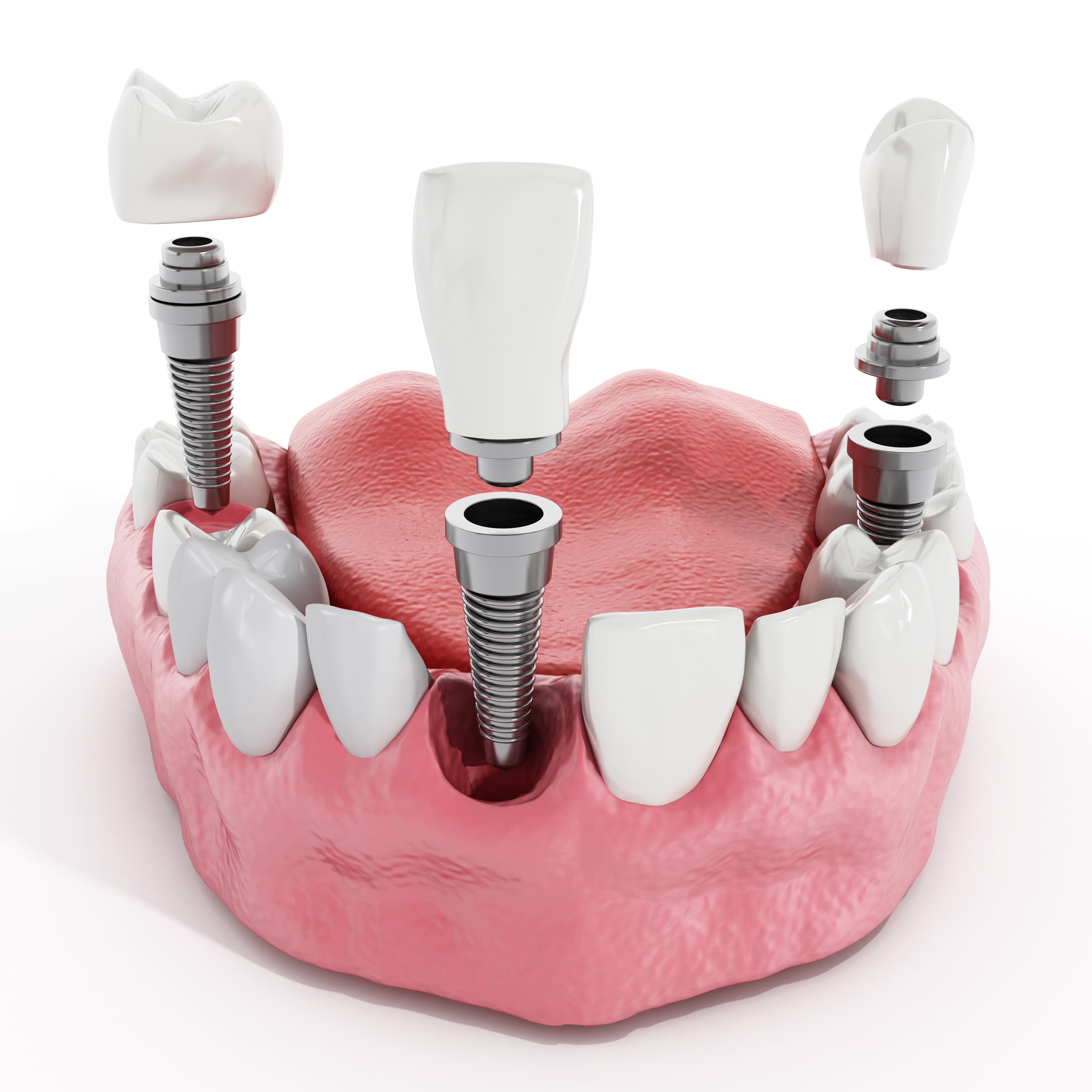 Choosing An Implant Dentist In Palm Beach Gardens Fl