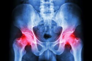 Can Hip Osteoarthritis Be Prevented?