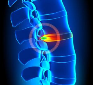 Can a Chiropractor Fix a Herniated Disc?