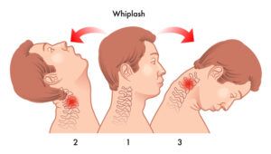 How Do I Know If I Have Whiplash?