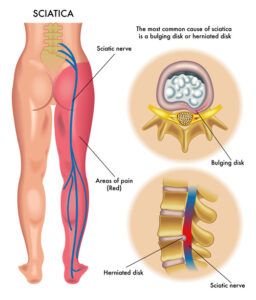 Sciatica Relief: Chiropractic Treatment Guide