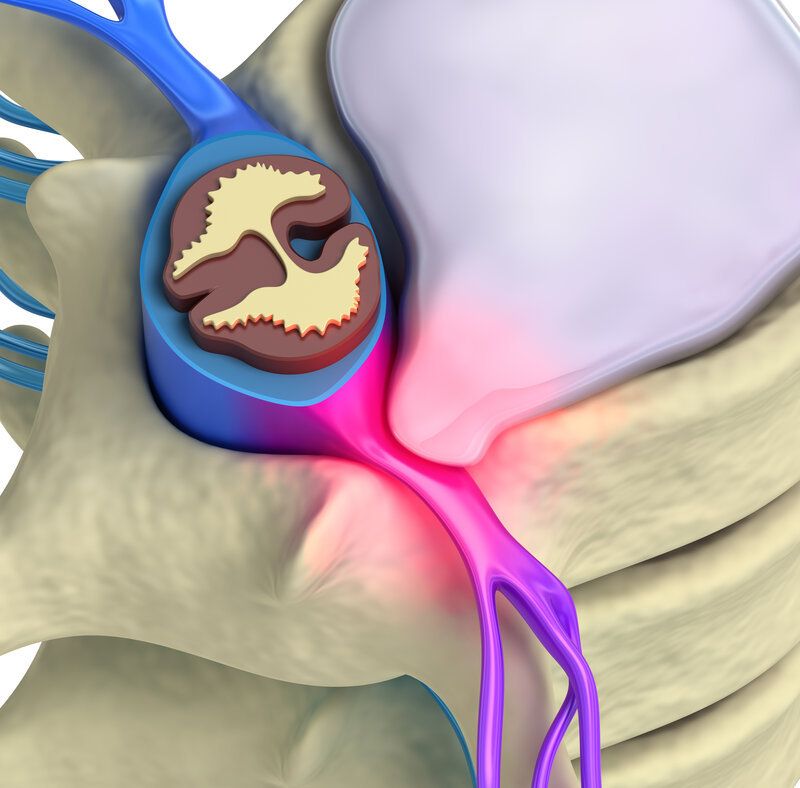 Relief from Sciatica: Non-Surgical Spinal Decompression Explained
