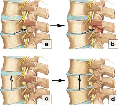 Managing Spinal Degeneration With Chiropractic Treatment