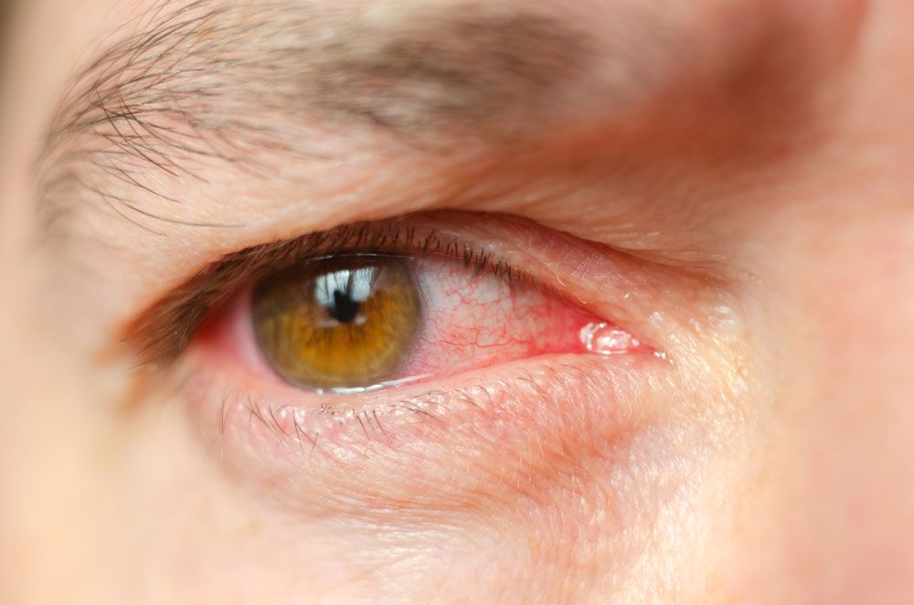 What Are Symptoms for Common Eye Infections?