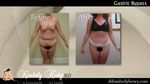 Body Lift