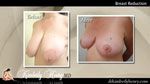 Breast Lift