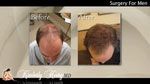 Plastic Surgery for Men