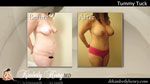 Tummy Tuck