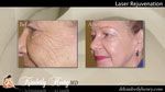 co2 Laser Treatment
