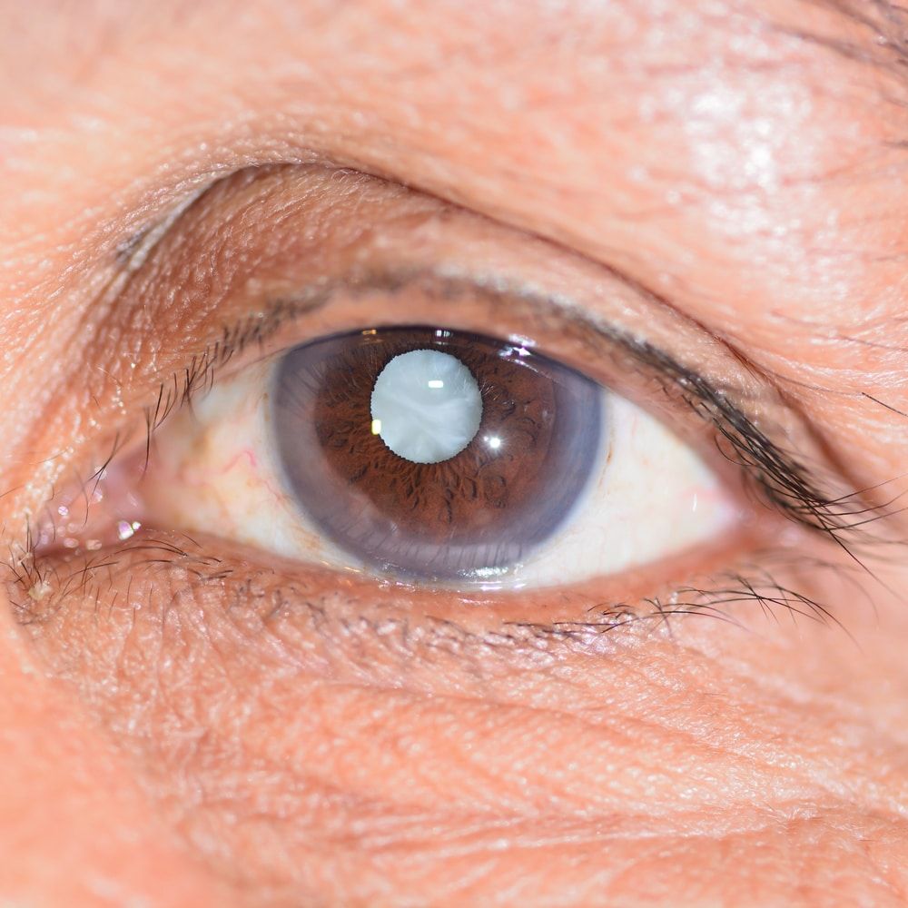 What are Traumatic Cataracts?