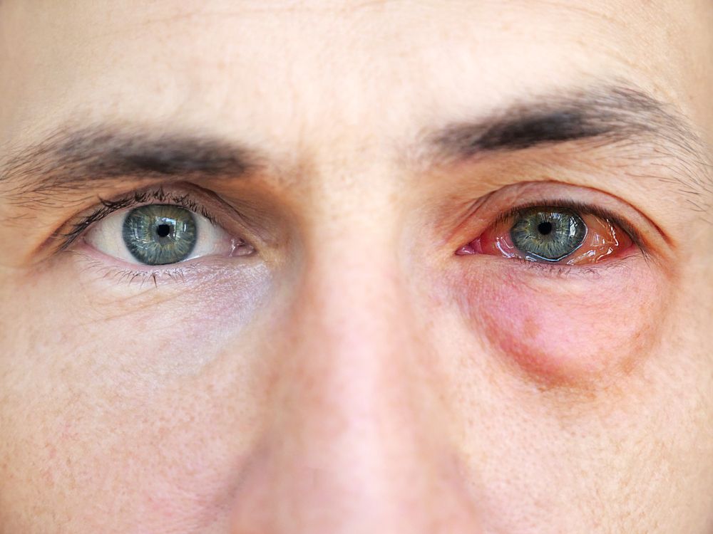 What Is the Most Common Eye Infection?