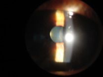 Dry Eye Evaluation