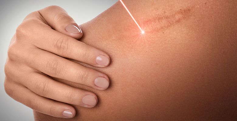 laser treatments