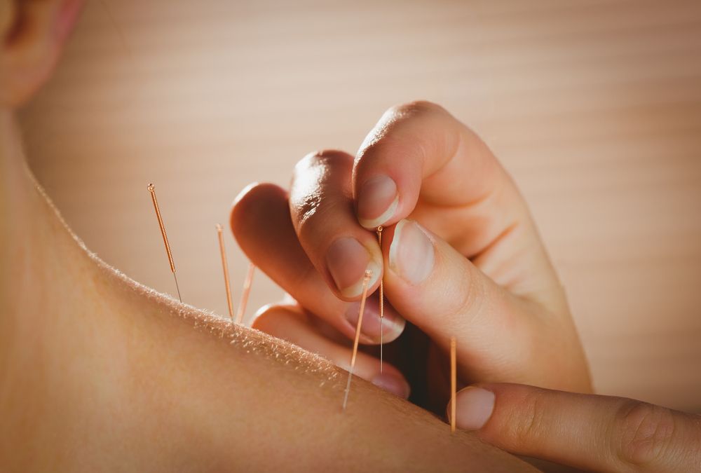 5 Surprising Benefits of Acupuncture You Never Knew