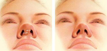 Open rhinoplasty incision across the columella