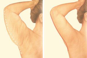 Back of arm incision