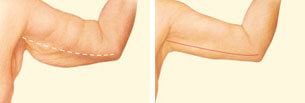 Inner arm incision