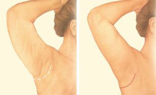 Minimal incision