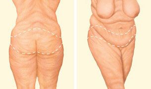 The incision