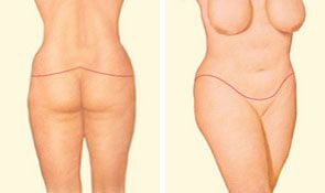 Closing the incisions