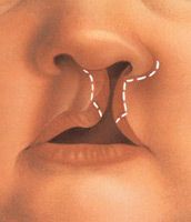 The incision