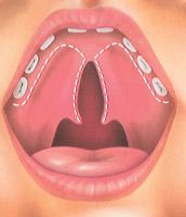The incision
