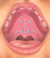 Closing  the incision