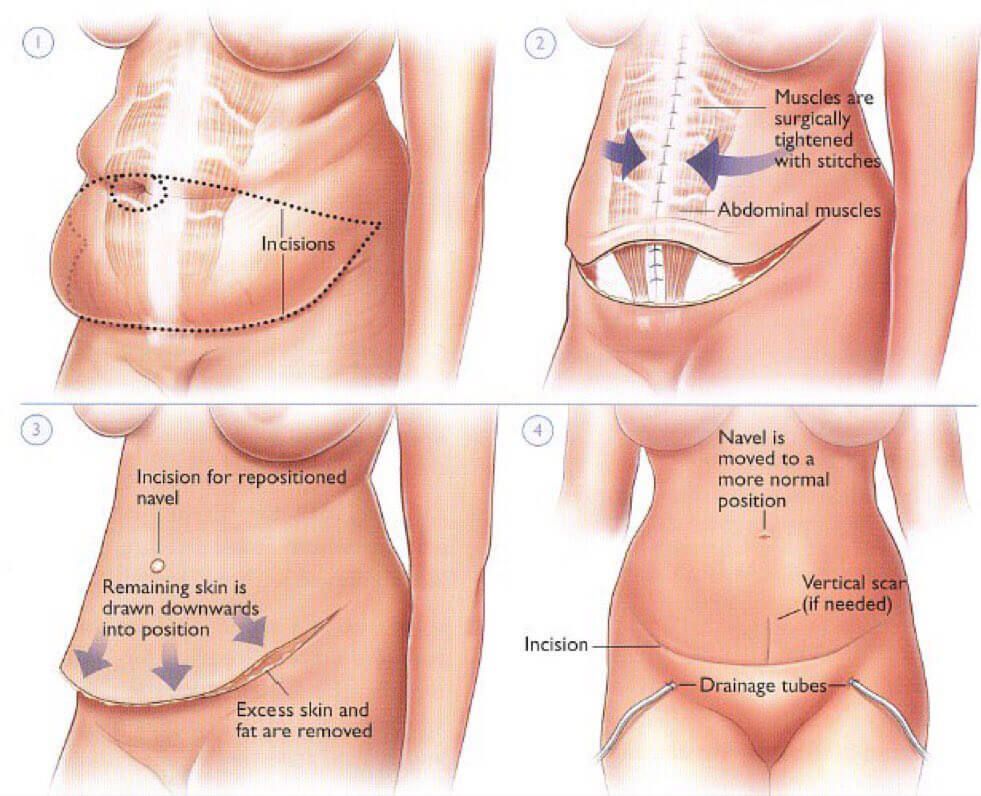 Abdominal