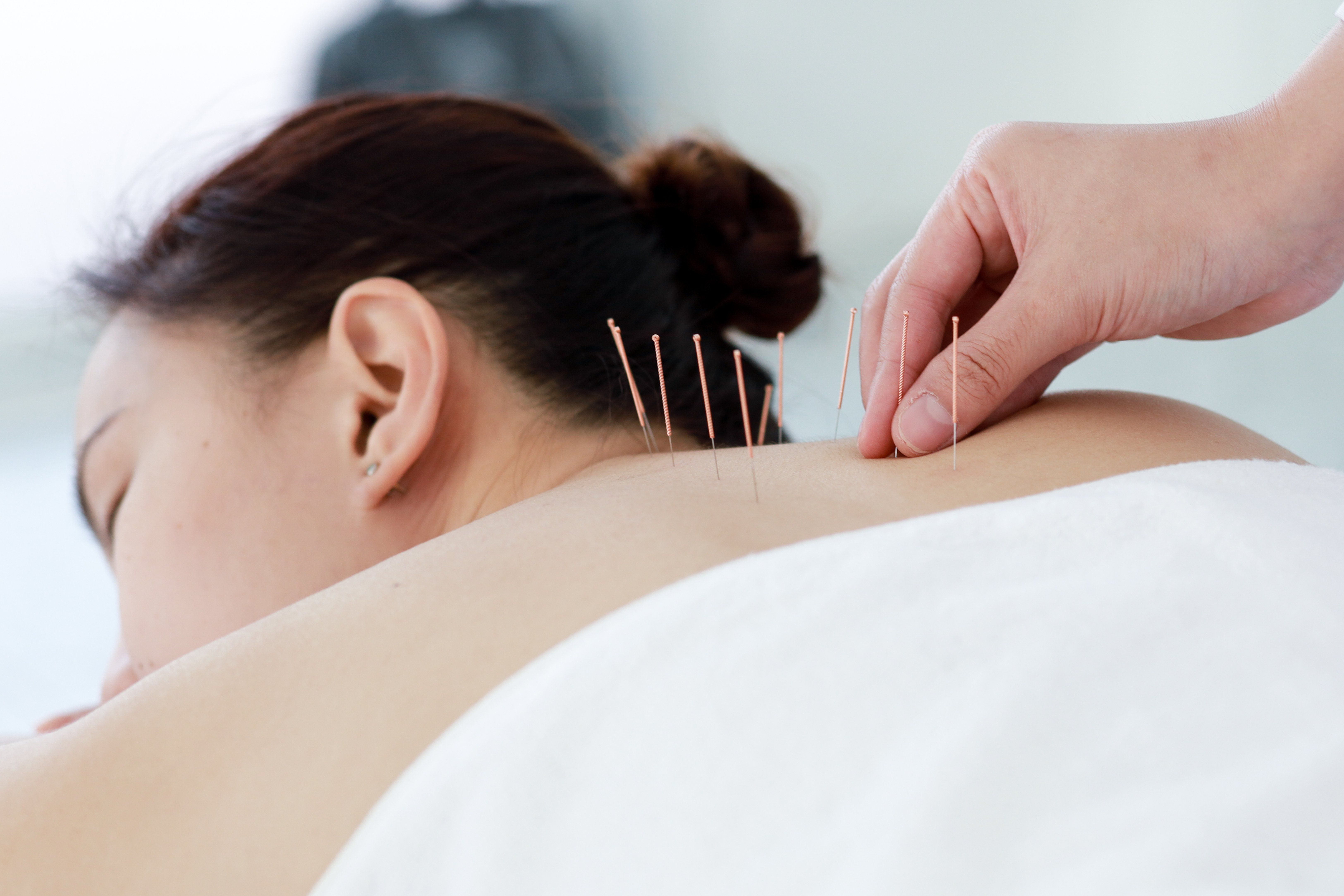 5 Conditions That Acupuncture Can Help Treat