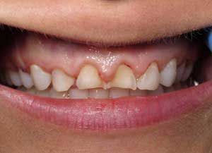 broken teeth