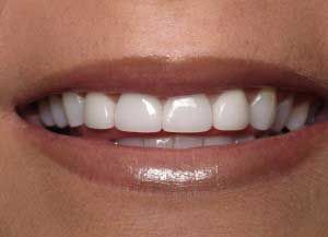 new teeth