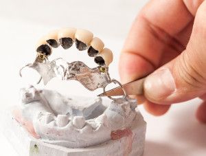 dental bridge