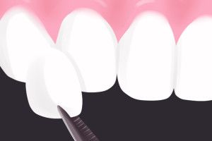 veneers