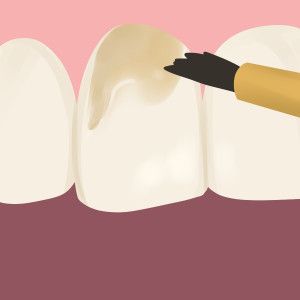 fluoride treatment