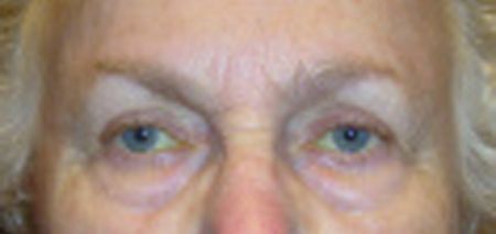 After eyelid surgery