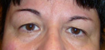 Before eyelid surgery