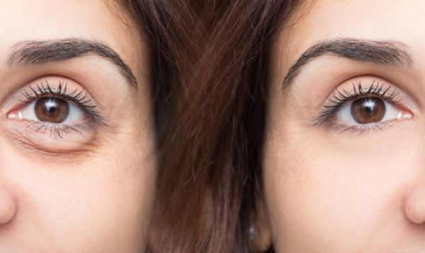 What Does the Eyelid Self-Evaluation Test Detect? 