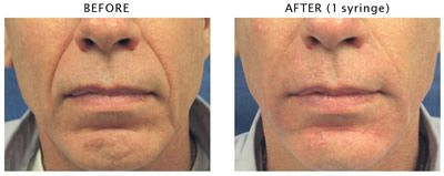 Before and after cosmetic fillers